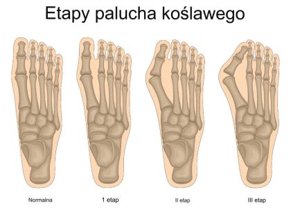 Schemat anatomiczny przedstawiający cztery etapy rozwoju palucha koślawego, od stopy normalnej do zaawansowanej deformacji