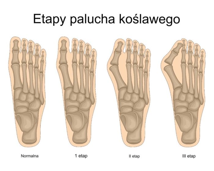 Schemat anatomiczny przedstawiający cztery etapy rozwoju palucha koślawego, od stopy normalnej do zaawansowanej deformacji