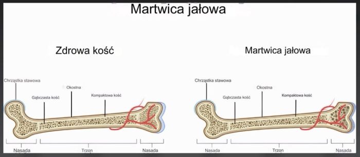 zmiany w kości piszczelowej pod wpływem martwicy kości