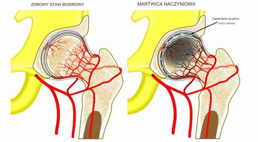 jałowa martwica kości zdrowy staw biodrowy i chory