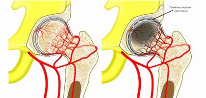 jałowa martwica kości zdrowy staw biodrowy i chory