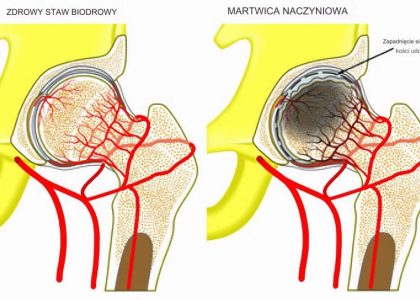 jałowa martwica kości zdrowy staw biodrowy i chory